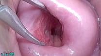 Uncensored Asian Milf Cervix Stretched Open Wide to watch inside the expandided Uterus